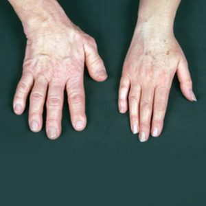 Acromegaly